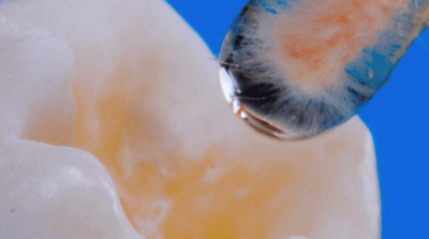 Adhesion in dentistry