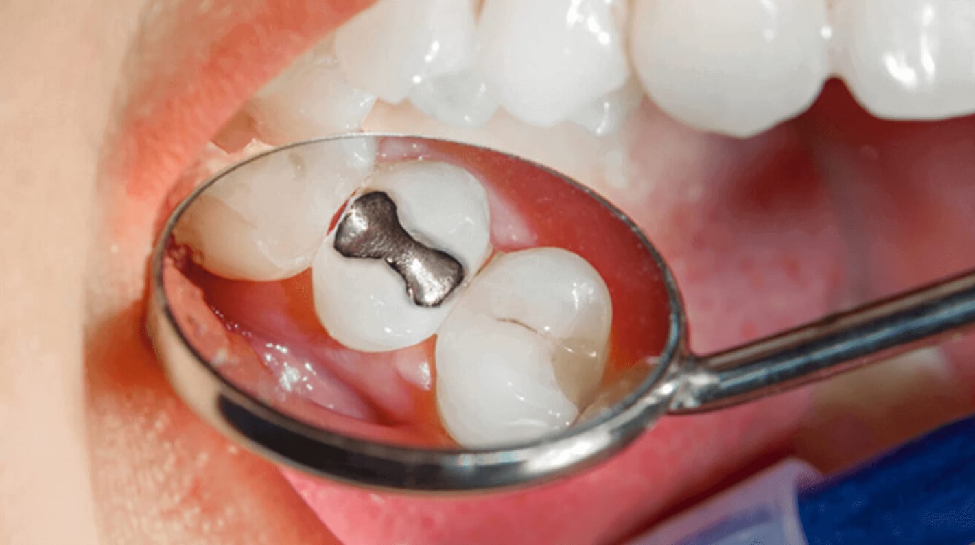 Use of amalgam in the dental clinic