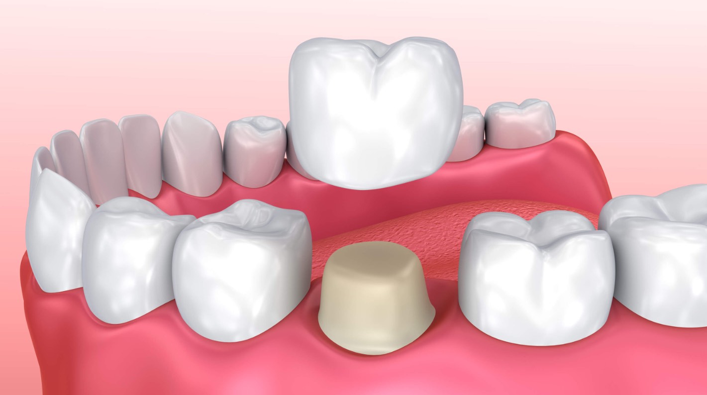 Bridges, crowns y dental veneers