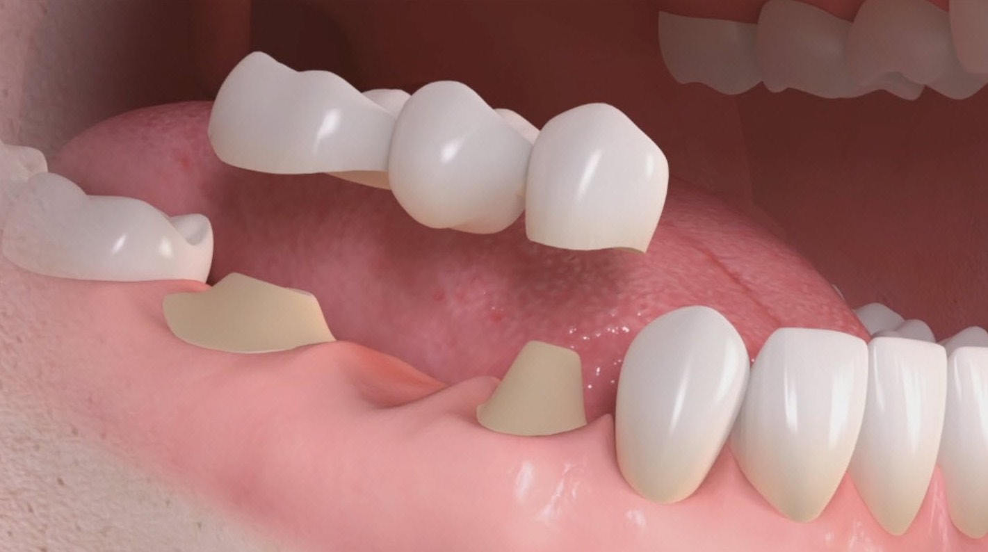 Dental bridges