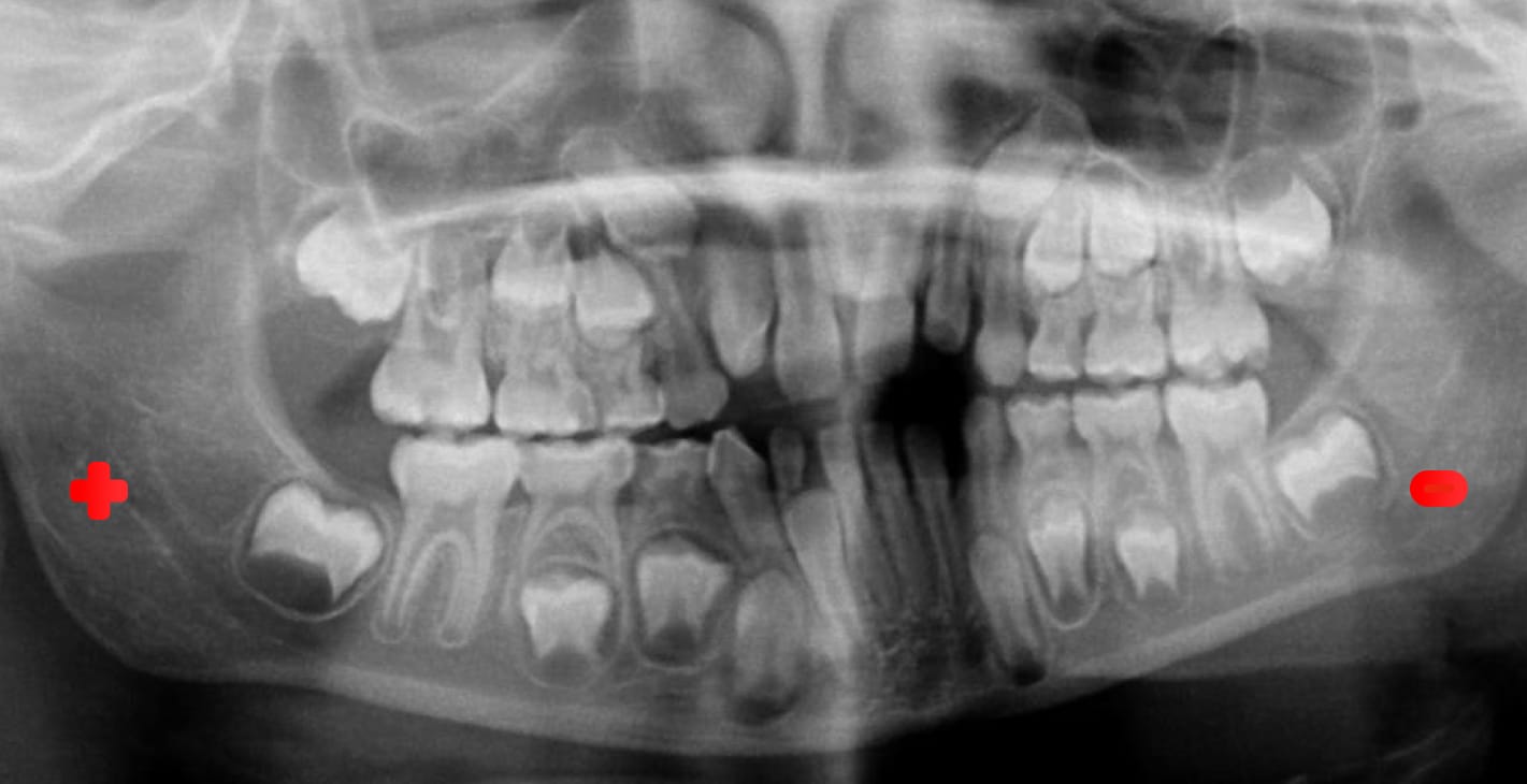 One side of the radiograph is magnified and the other side is reduced in OPG