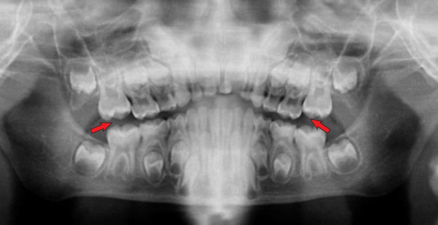 Flat or upward curved smile line OPG