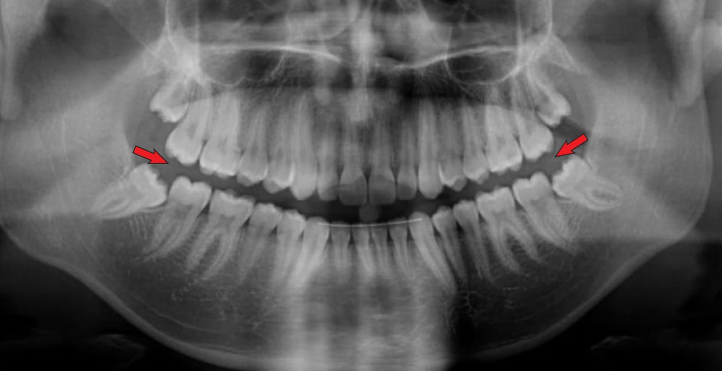 Exaggerated smile line or like a bird's beak