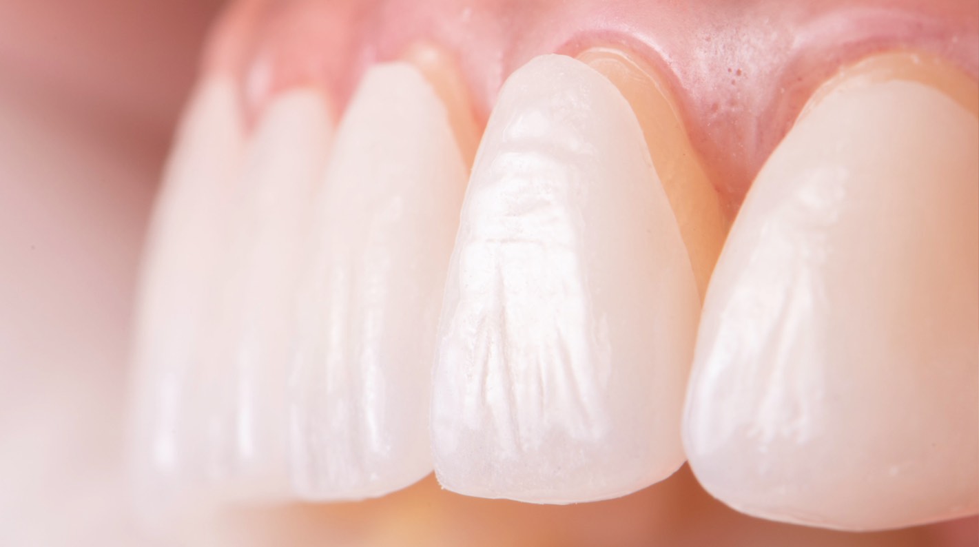 Dental veneers