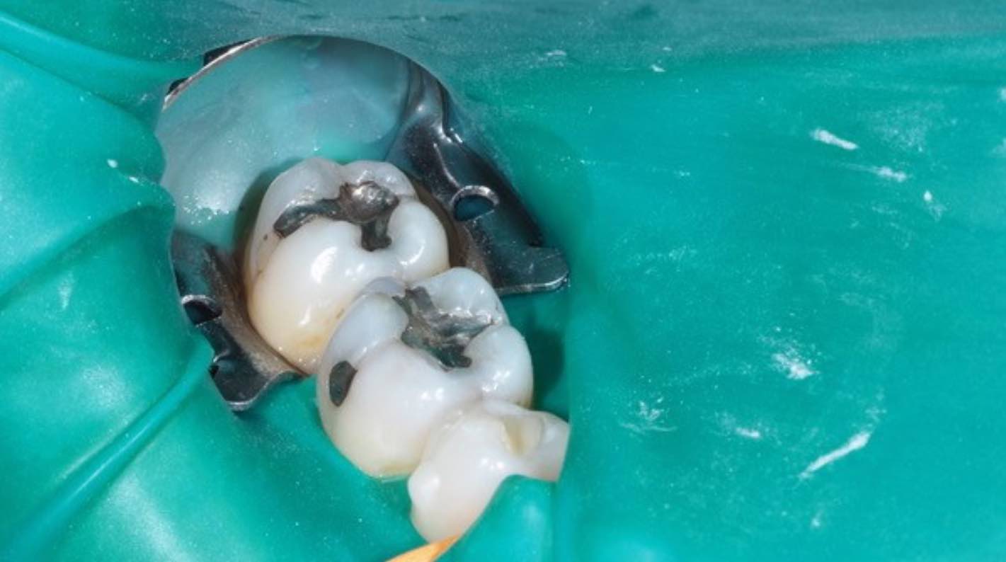 Remove an amalgam restoration safely