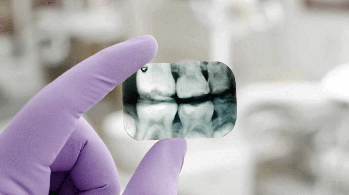 Toxic residues from radiographic films