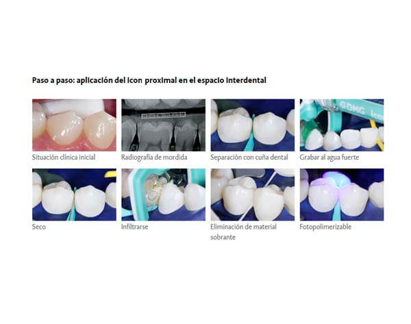 Icon Proximal application in interdental space