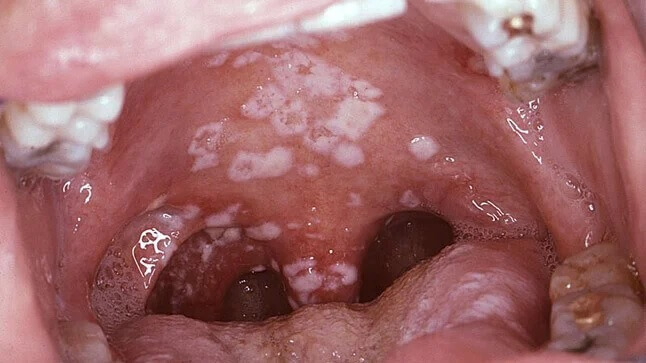 Candidiasis oral 