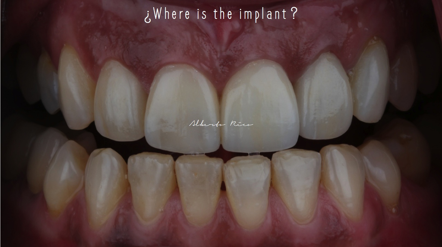 Caso clínico implante dental parte 1