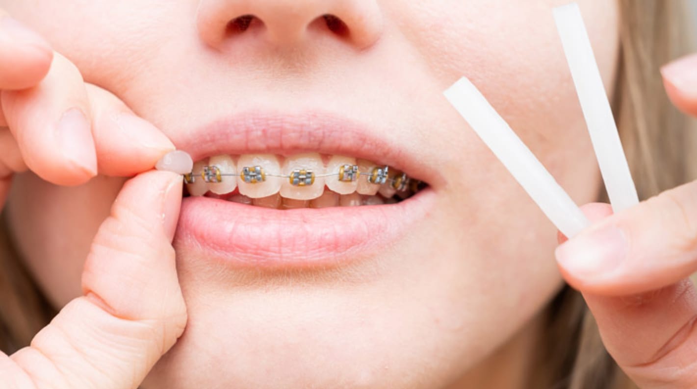 Orthodontic wax