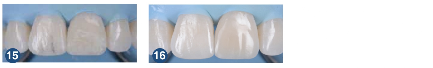 Restauración con G-aenial A’CHORD