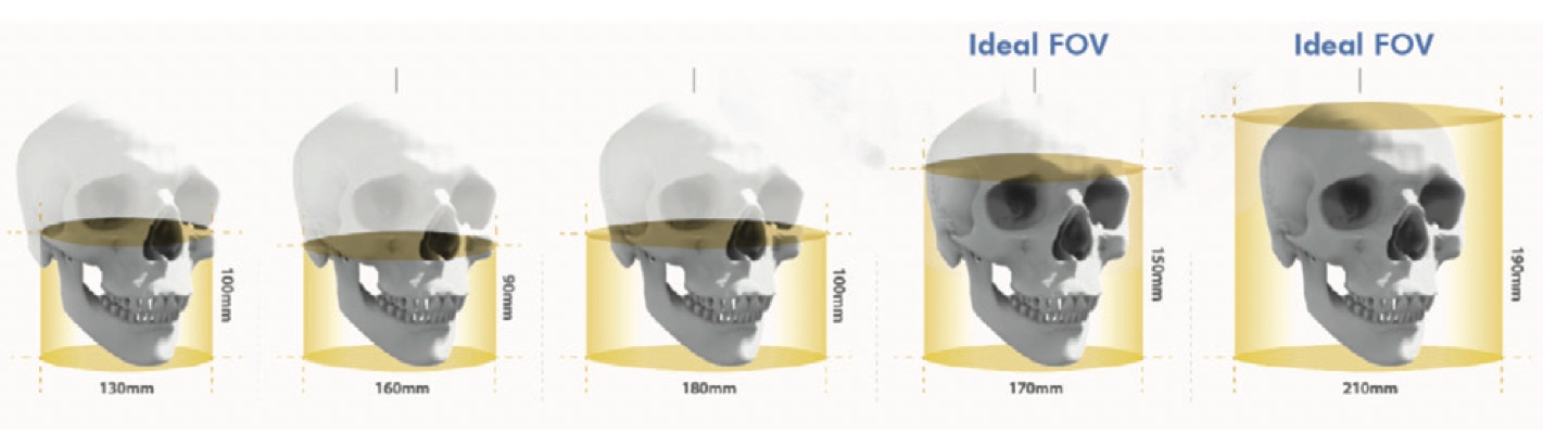 Distintos tipos de FOV en CBCT