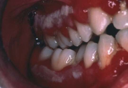 Eritema Gingival Lineal