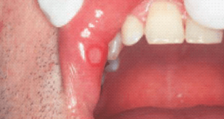 Estomatitis aftosa