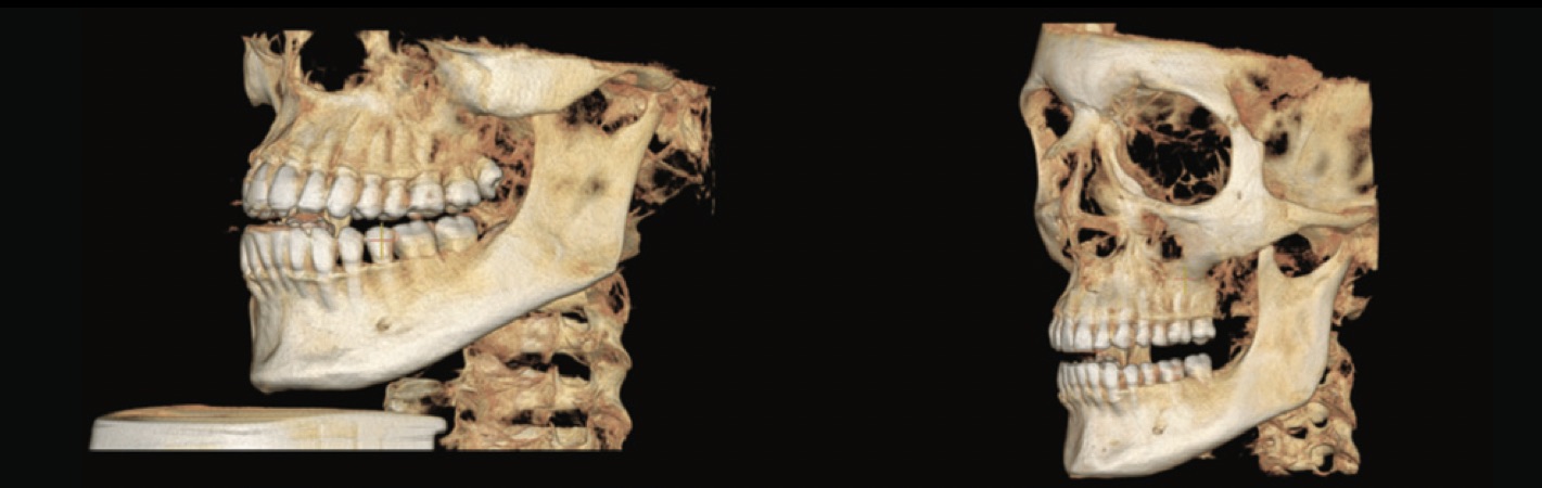 Comparativa imagen CBCT FOV 16 x 10 versus FOV 15 x 15