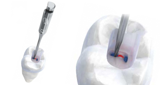 Fresa dental para endodoncia Endo Explorer de Komet