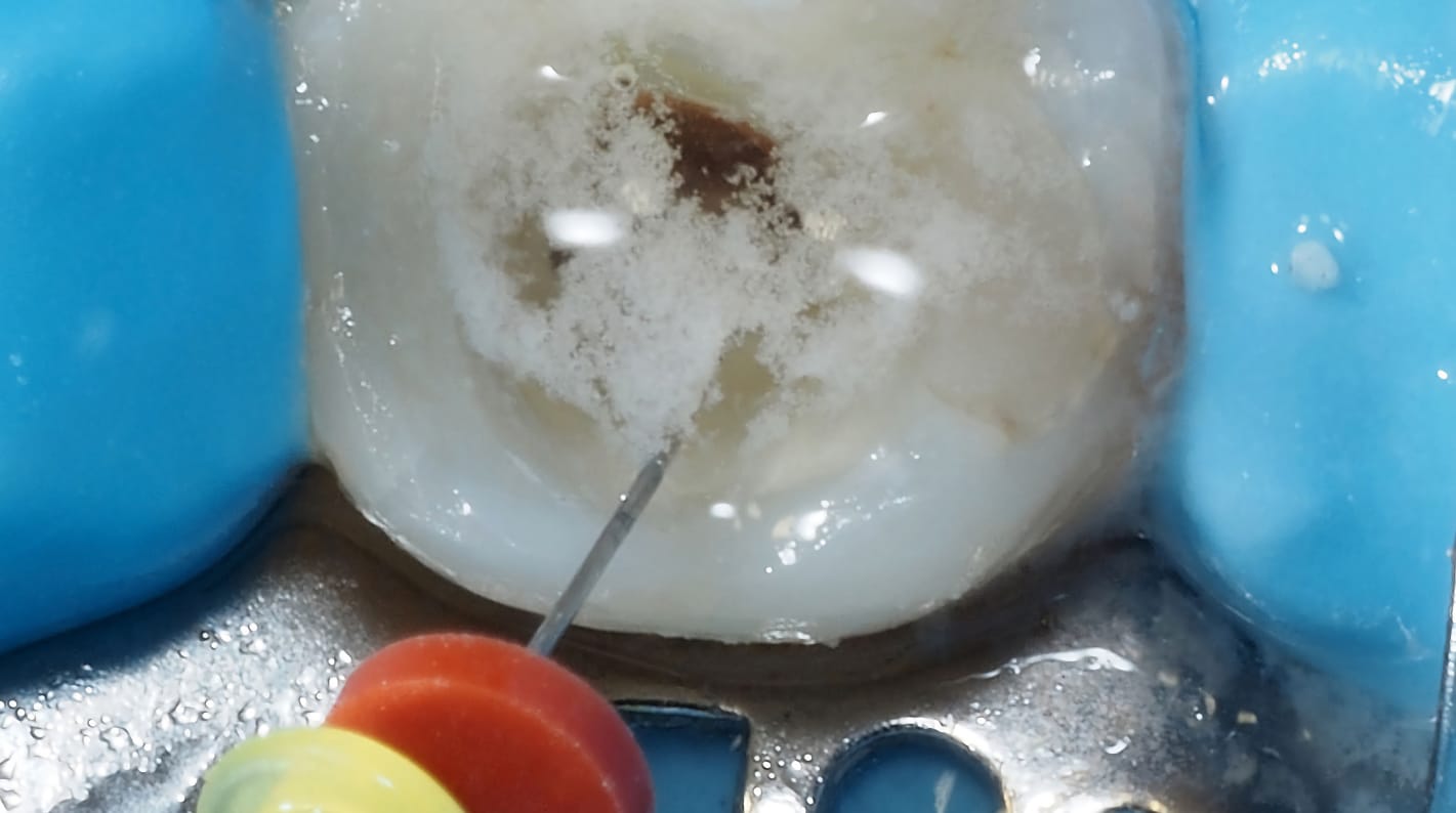 Soluciones irrigantes en endodoncia