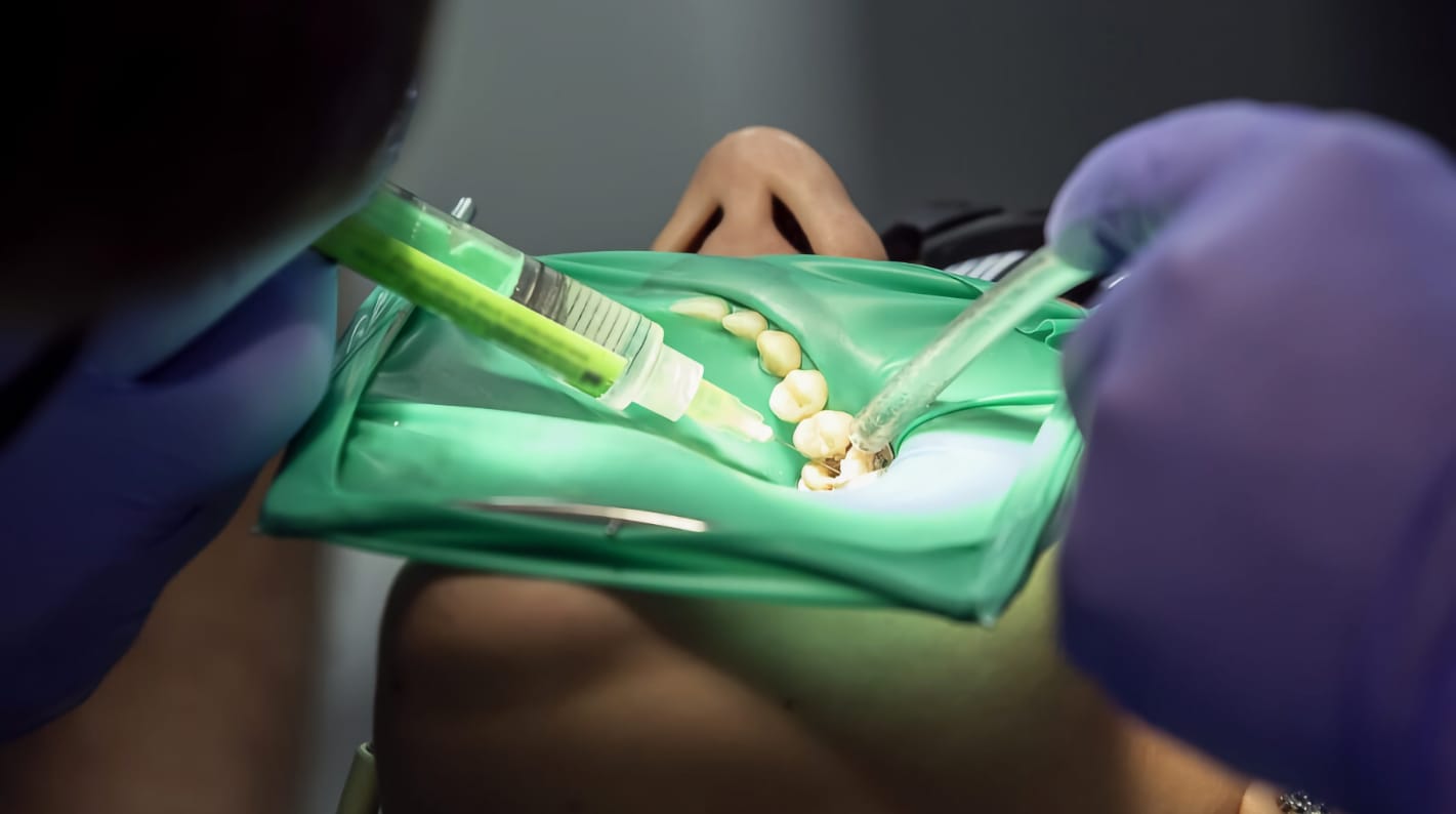 Soluciones irrigantes en endodoncia
