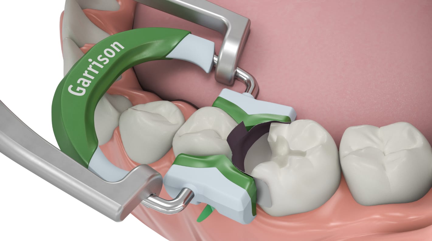 Matrices dentales preformadas Garrison