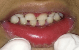 Mucositis