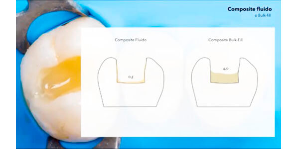Composite fluido o Bulk fill