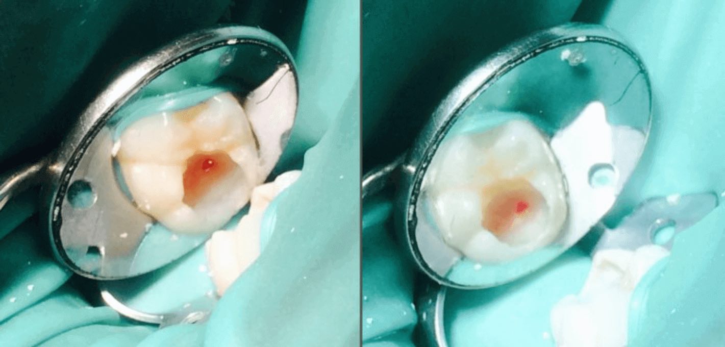 Direct pulp capping