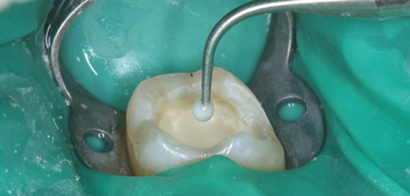 Indirect pulp capping