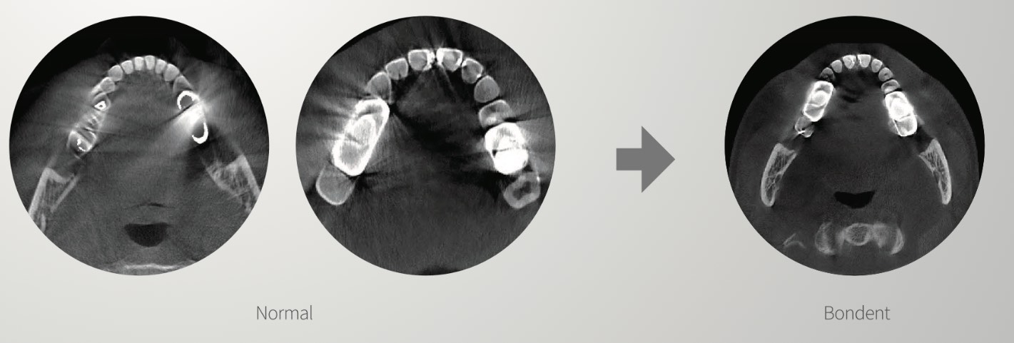 Reducción de artefactos en CBCT Bondent