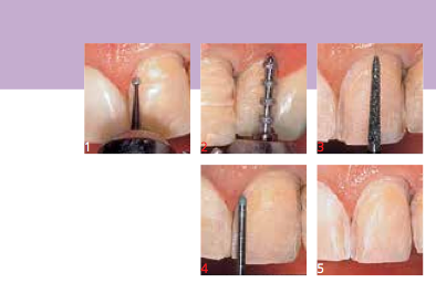 Stages of the preparation of veneers